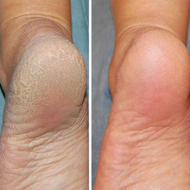 Pieds de star : Votre secret SilkySoles